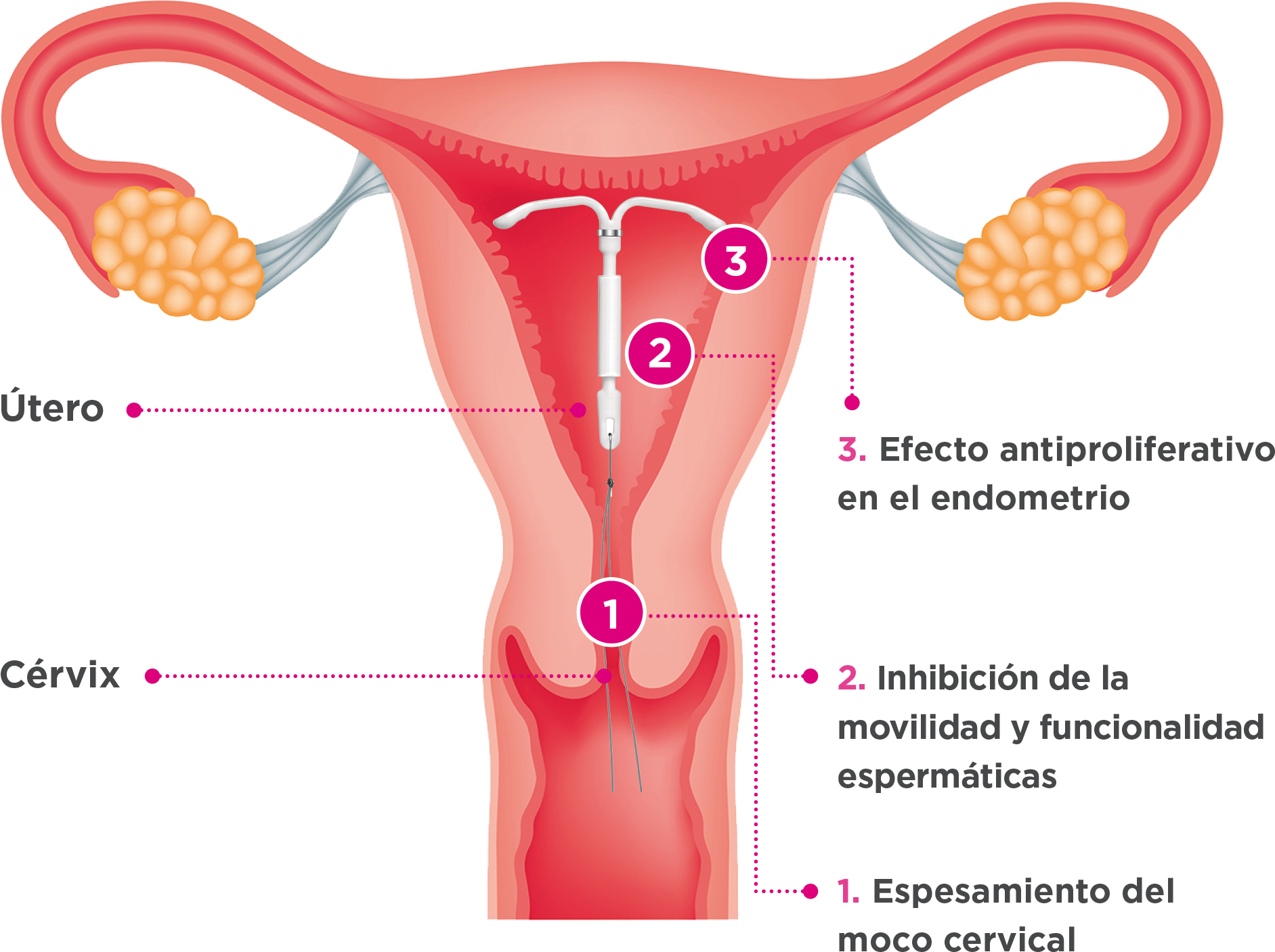 Conoce el DIU | MyContraception Spain